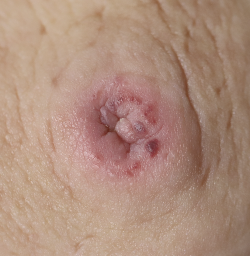 nipple blood blister